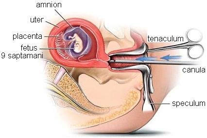 Reforma legii avortului